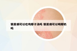 銀屑病可以吃雞椰子湯嗎 銀屑病可以喝椰奶嗎