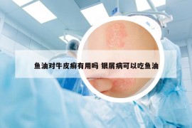 魚(yú)油對(duì)牛皮癬有用嗎 銀屑病可以吃魚(yú)油