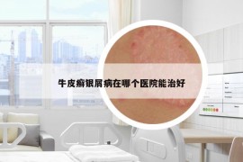 牛皮癬銀屑病在哪個(gè)醫(yī)院能治好