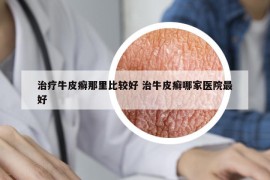 治療牛皮癬那里比較好 治牛皮癬哪家醫(yī)院最好