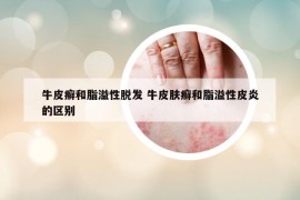 牛皮癬和脂溢性脫發(fā) 牛皮膚癬和脂溢性皮炎的區(qū)別