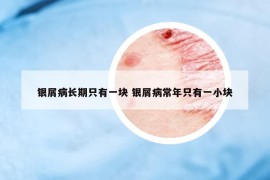 銀屑病長期只有一塊 銀屑病常年只有一小塊
