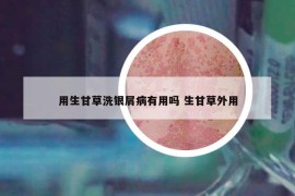 用生甘草洗銀屑病有用嗎 生甘草外用
