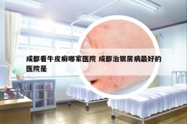 成都看牛皮癬哪家醫(yī)院 成都治銀屑病最好的醫(yī)院是