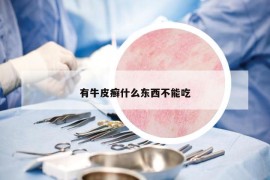 有牛皮癬什么東西不能吃