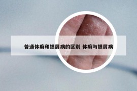 普通體癬和銀屑病的區(qū)別 體癬與銀屑病