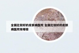 全國(guó)比較好的皮膚病醫(yī)院 全國(guó)比較好的皮膚病醫(yī)院有哪些