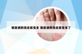 銀屑病熬夜皮屑變多 銀屑病熬夜皮屑變多了