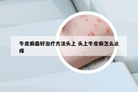 牛皮癬最好治療方法頭上 頭上牛皮癬怎么止癢