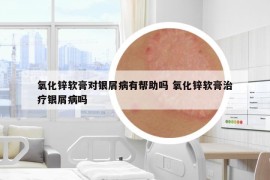 氧化鋅軟膏對(duì)銀屑病有幫助嗎 氧化鋅軟膏治療銀屑病嗎