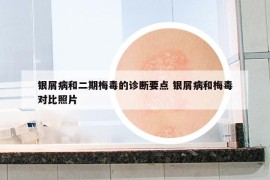 銀屑病和二期梅毒的診斷要點 銀屑病和梅毒對比照片