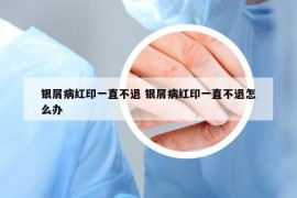 銀屑病紅印一直不退 銀屑病紅印一直不退怎么辦