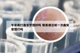 牛皮癬打曲安奈德好嗎 銀屑病注射一次曲安奈德行嗎