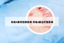 異維A酸導(dǎo)致銀屑病 異維a酸治療銀屑病
