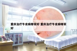重慶治療牛皮癬那家好 重慶治療牛皮癬哪家好