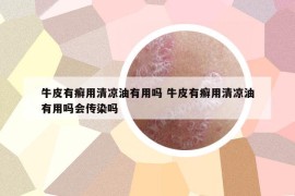牛皮有癬用清涼油有用嗎 牛皮有癬用清涼油有用嗎會(huì)傳染嗎