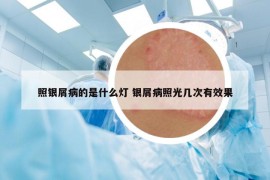 照銀屑病的是什么燈 銀屑病照光幾次有效果