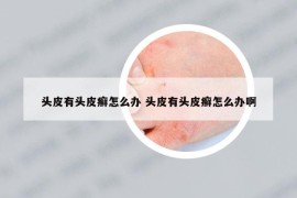 頭皮有頭皮癬怎么辦 頭皮有頭皮癬怎么辦啊