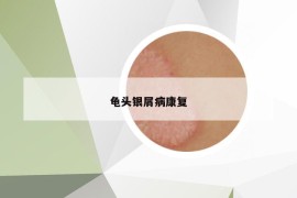 龜頭銀屑病康復