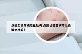 點(diǎn)滴型銀屑病能化驗(yàn)嗎 點(diǎn)滴狀銀屑病可以輸液治療嗎?