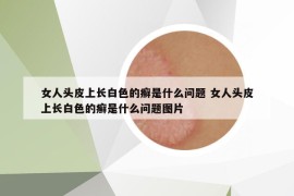 女人頭皮上長(zhǎng)白色的癬是什么問(wèn)題 女人頭皮上長(zhǎng)白色的癬是什么問(wèn)題圖片