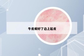 牛皮癬好了邊上起皮
