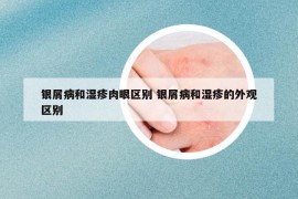 銀屑病和濕疹肉眼區(qū)別 銀屑病和濕疹的外觀(guān)區(qū)別