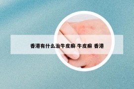 香港有什么治牛皮癬 牛皮癬 香港