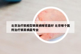 北京治療膿皰型銀屑病哪家最好 北京哪個(gè)醫(yī)院治療銀屑病最專業(yè)