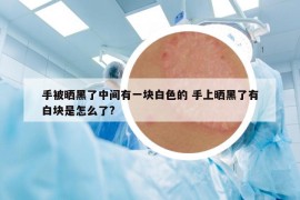 手被曬黑了中間有一塊白色的 手上曬黑了有白塊是怎么了?