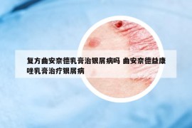 復方曲安奈德乳膏治銀屑病嗎 曲安奈德益康唑乳膏治療銀屑病