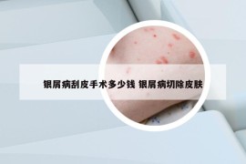 銀屑病刮皮手術(shù)多少錢 銀屑病切除皮膚