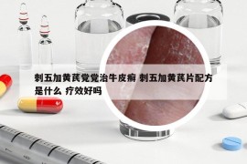 刺五加黃芪黨黨治牛皮癬 刺五加黃芪片配方是什么 療效好嗎