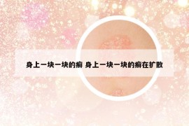 身上一塊一塊的癬 身上一塊一塊的癬在擴散