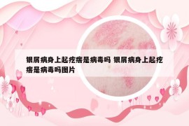 銀屑病身上起疙瘩是病毒嗎 銀屑病身上起疙瘩是病毒嗎圖片