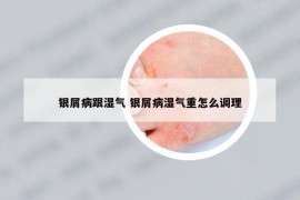 銀屑病跟濕氣 銀屑病濕氣重怎么調理