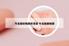 牛皮癬的晚期并發(fā)癥 牛皮膚癬晚期