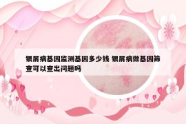 銀屑病基因監(jiān)測(cè)基因多少錢 銀屑病做基因篩查可以查出問(wèn)題嗎