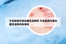 牛皮膚癬可用白醋洗涂擦嗎 牛皮膚癬可用白醋洗涂擦嗎有用嗎