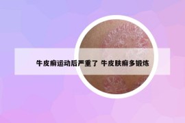 牛皮癬運動后嚴(yán)重了 牛皮膚癬多鍛煉