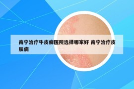 南寧治療牛皮癬醫(yī)院選擇哪家好 南寧治療皮膚病