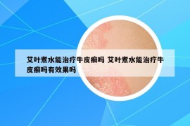 艾葉煮水能治療牛皮癬嗎 艾葉煮水能治療牛皮癬嗎有效果嗎