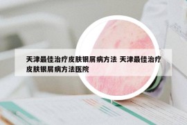 天津最佳治療皮膚銀屑病方法 天津最佳治療皮膚銀屑病方法醫(yī)院