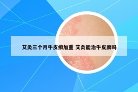 艾灸三個月牛皮癬加重 艾灸能治牛皮廨嗎