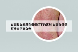 白斑和白癜風(fēng)在伍德燈下的區(qū)別 白斑在伍德燈檢查下亮白色