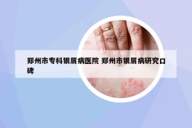 鄭州市?？沏y屑病醫(yī)院 鄭州市銀屑病研究口碑