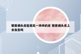 銀屑病頭皮能摳出一塊塊的皮 銀屑病頭皮上會自愈嗎