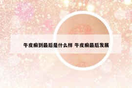 牛皮癬到最后是什么樣 牛皮癬最后發(fā)展