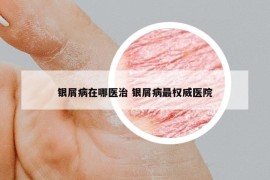 銀屑病在哪醫(yī)治 銀屑病最權(quán)威醫(yī)院