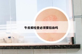 牛皮癬檢查必須要驗(yàn)血嗎